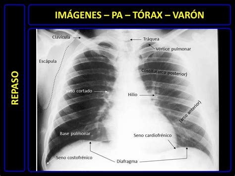 Diagnóstico Por Imágenes Radiografía De Tórax Normal