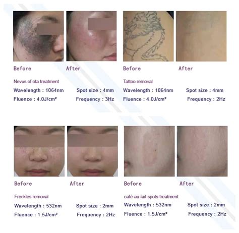 Q Switched Nd Yag Ndyag Laser For Tattoo Removal Skin Whitening