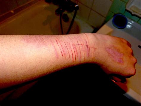 cut arm  harm