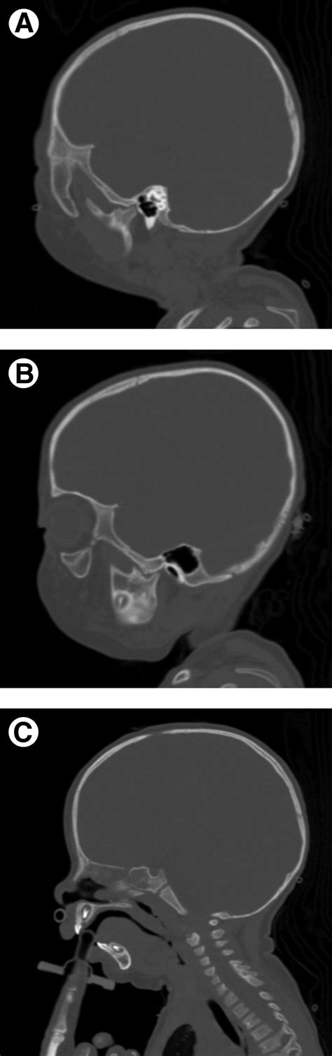 Distraction Osteogenesis As A Treatment For Retrognathia And