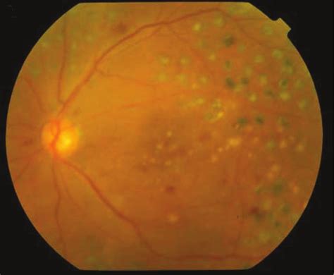 Laser Photocoagulation Combined With Subtenon Injection Of