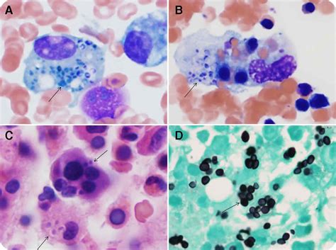 What Is Hlh Disease Pathology Outlines Diseases Club Center