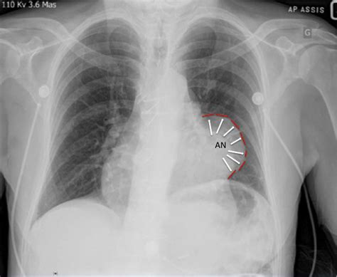 Anteroposterior Chest Radiograph Showing A Round Mass In The