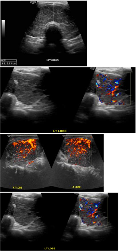 Thyroid Ultrasound Thyroid Parenchyma Shows Diffuse Heterogenous