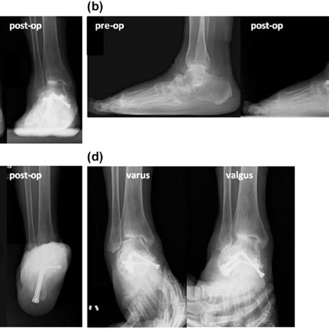 Preoperative And Follow Up Weight Bearing Radiographs A