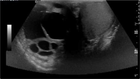 Right Scrotum Complex Cystic Mass Download Scientific Diagram