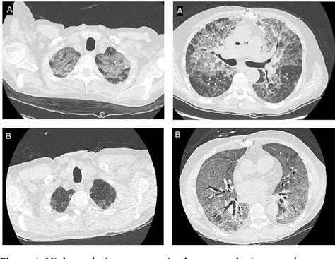 Figure 1 From Pneumocystis Jirovecii Pneumonia After Heart Transplantation Two Case Reports And