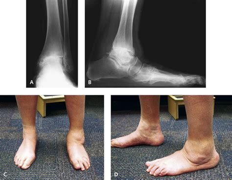 Total Ankle Replacement Plastic Surgery Key