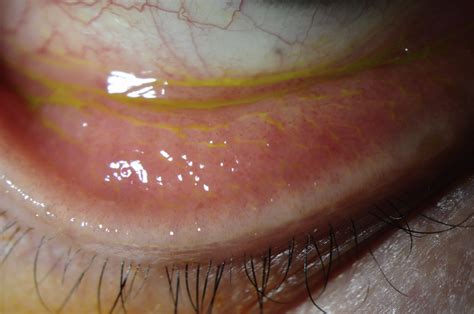 Adenoviral Keratoconjunctivitis Survey Of Ophthalmology