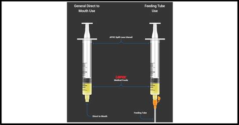 PEG feeding. PEG feed training. PEG feeding tube. – APOC Science