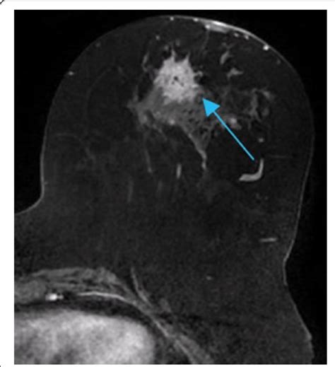 Axial Fat Suppressed T1 Weighted First Post Contrast Image Of A Breast