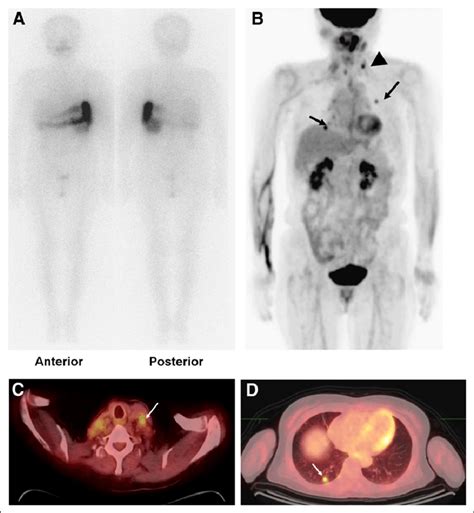 A 72 Y Old Woman With Papillary Thyroid Cancer Underwent 131 I Ablation