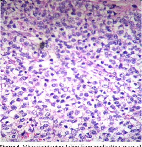 Figure 4 From Case Report Pathology Clinical And Immunohistopathologic