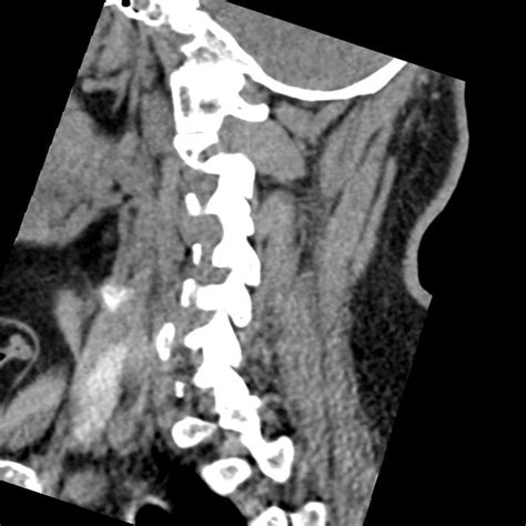 Cervical Spinal Neurofibroma In A Patient With Nf Radiopaedia