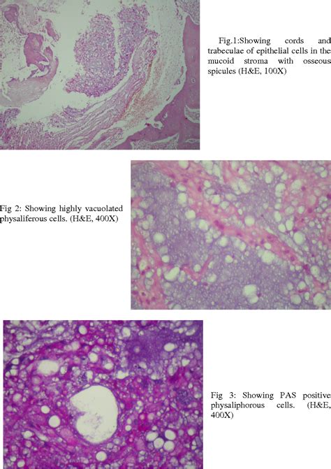 Figure From Chordoma Of Lumbar Spine Semantic Scholar