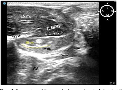 Figure 1 From Ultrasound Guided Dorsolateral Approach For Quadratus