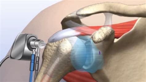 Arthroscopic Shoulder Reconstructive Surgery – Dr. Amrut Borade