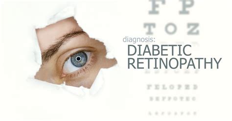 Volkskrankheit Diabetes Regelm Iges Screening Beim Augenarzt Sinnvoll