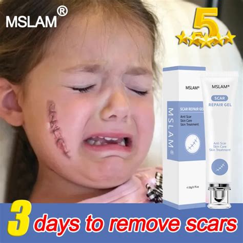 5 Days Recovery Mslam Peklat Remover Cream Burn Scar Repair Acne Cream