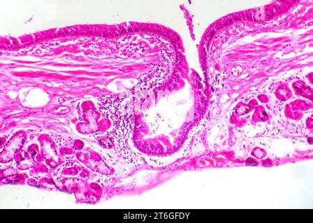 Photomicrograph Of Bronchial Epithelial Squamous Metaplasia Showing