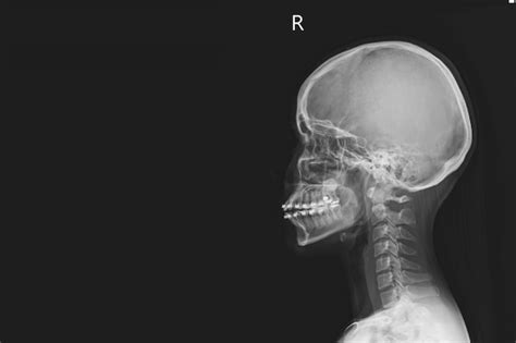 Premium Photo Film X Ray Ls Spine Lateral View Showing Burst Fracture Of L2 Vertebral Body