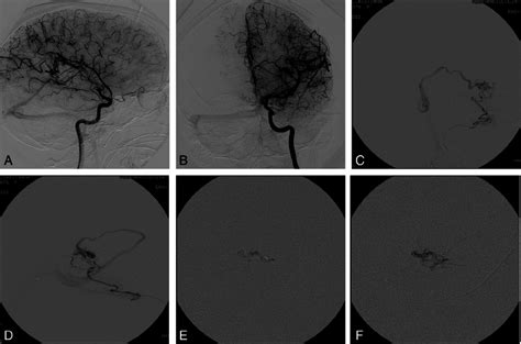 Case Pretreatment Dsa Examination In Anteroposterior Ap A And