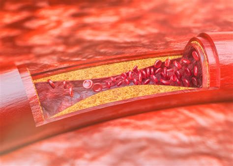 Aterosclerose O Que Sintomas E Fatores De Risco