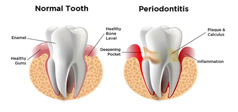 Periodontal Treatment – Dr. Brant Arnold