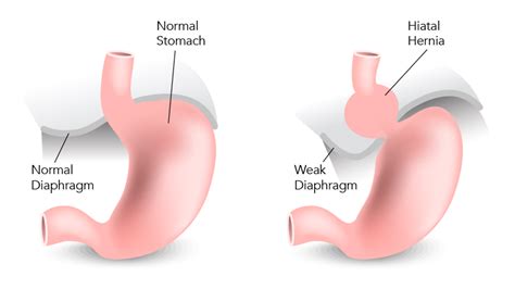 Jenis Hernia Atau Turun Berok Yang Perlu Kamu Ketahui