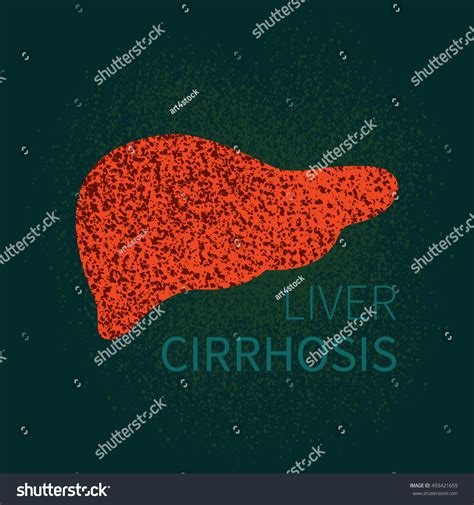 Liver Cirrhosis Disease Design Template Human Stock Vector Royalty Free 493421659