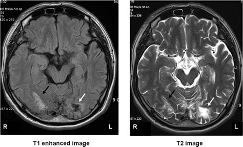 Occipital Lobe Stroke