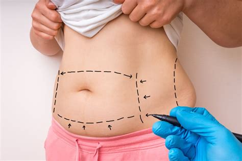 Tummy Tuck In Turkey Abdominoplasty Bookmedi Clinic