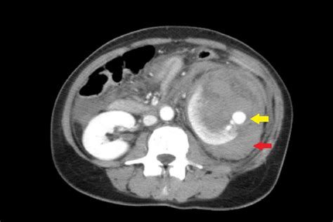 Figure 3 From Retroperitoneal Hemorrhage How To Detect Describe And