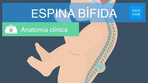 Espina bífida Definición causas tipos prevención y tratamiento