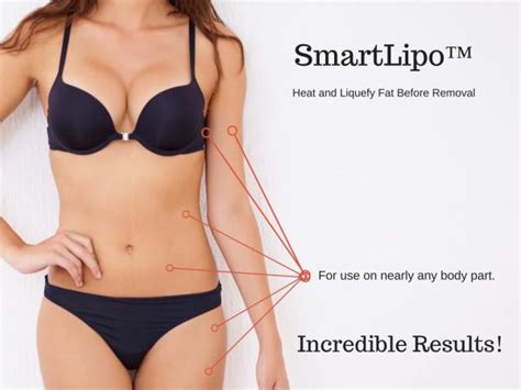 Smart Lipo Laser Lipo Infini Cosmetic Associates