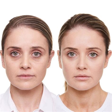 Dark Circles Under The Eyes Causes Of Dark Circles And Their Treatment