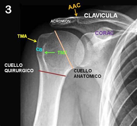 Utilidad De Las Proyecciones Radiogr Ficas En Hombro Doloroso Body