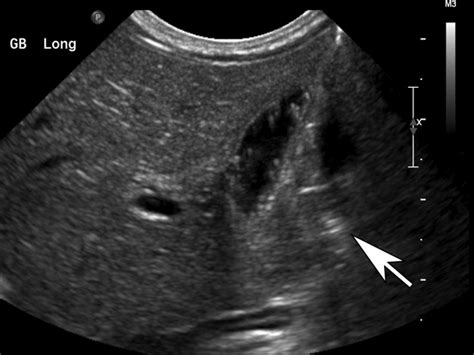 Cholesterol Gallstones Ultrasound