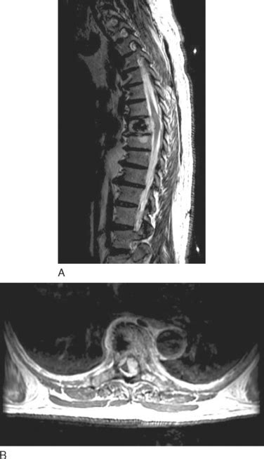 Tumors Of The Spinal Cord Neupsy Key