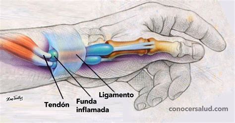 La Tendinitis Tenosinovitis De Quervain Es Una Afecci N Dolorosa Que