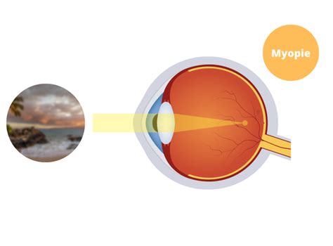 Myopie Ophtalmologie L Union