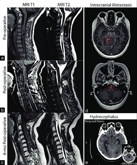 Magnetic Resonance Imaging T1 And T2 Sequences At A Preoperative Download Scientific Diagram