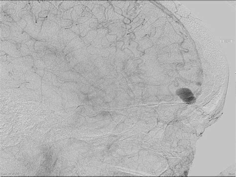 Cerebral Pial Arteriovenous Malformation Avm Ppt