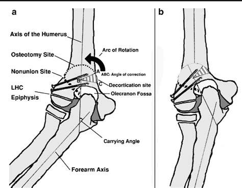 Cubitus Varus Deformity: