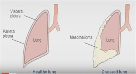 Pleural Mesothelioma | Mesothelioma