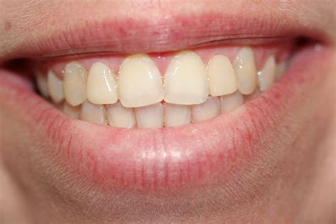 Maryland Dental Bridges Replace Your Missing Teeth Without Drilling