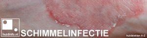 Schimmel Huidinfo Nl Dermatoloog Actuele Informatie