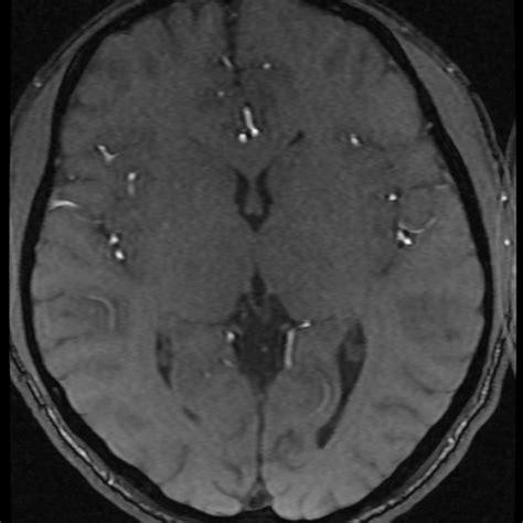 Azygos Anterior Cerebral Artery Radiopaedia 17059 16756 Axial MRA