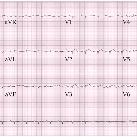 12 lead EKG significant for normal sinus rhythm, low voltage QRS ...