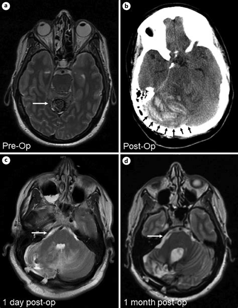 a Preoperative axial T2-weighted MRI image at the level of the pons... | Download Scientific Diagram